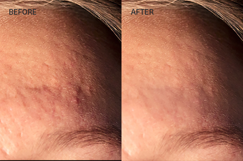 Multi-Polar RF Rejuvenation Infusion treatment before and after