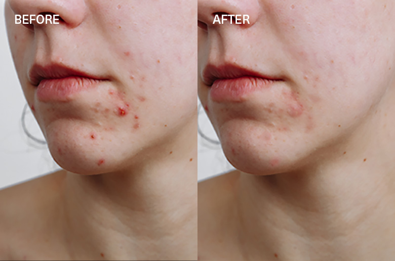 Active cleansing T zone and Chin before and after
